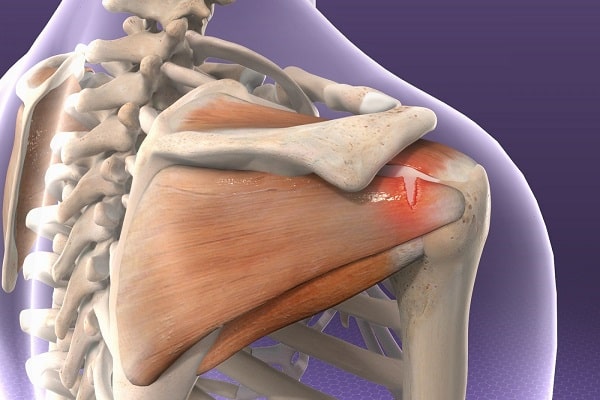 Rotator Cuff Sendromu